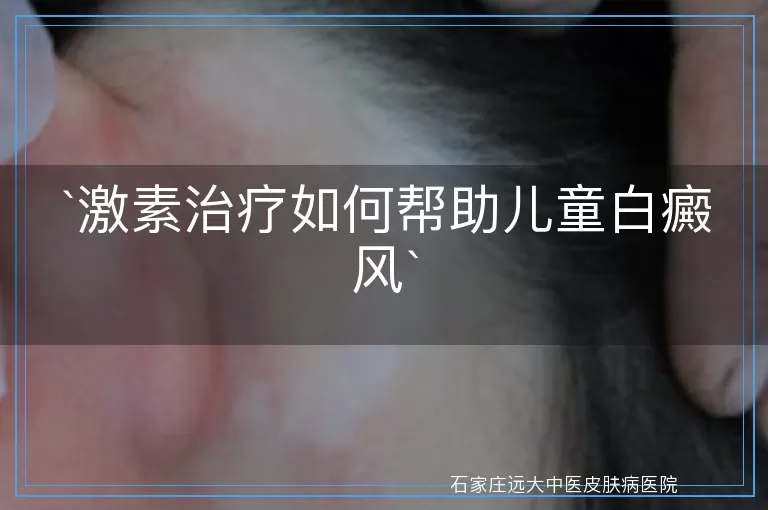 激素治疗如何帮助儿童白癜风