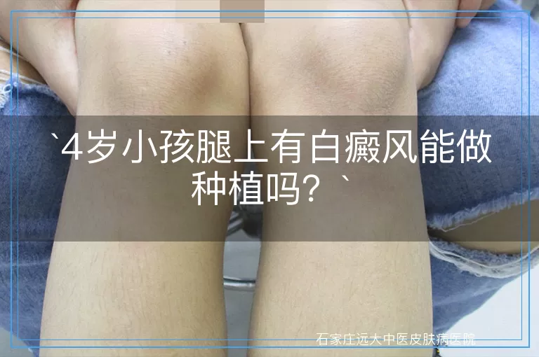 4岁小孩腿上有白癜风能做种植吗？