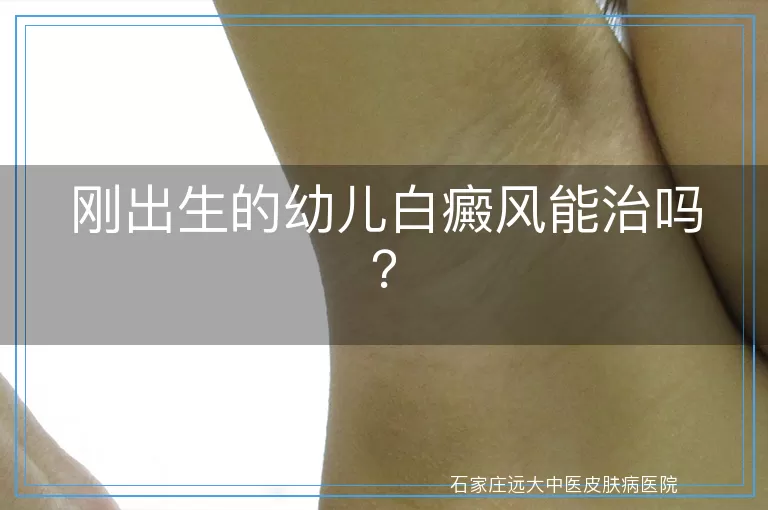 刚出生的幼儿白癜风能治吗？