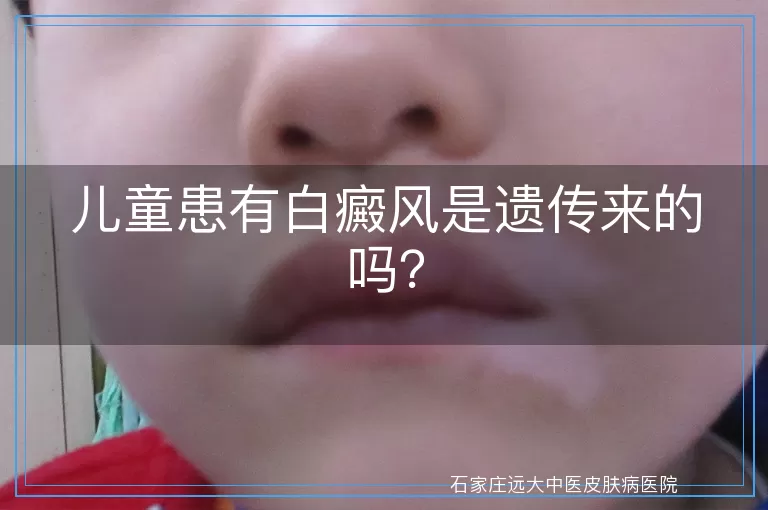 儿童患有白癜风是遗传来的吗？