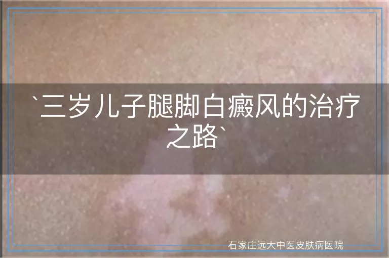 三岁儿子腿脚白癜风的治疗之路