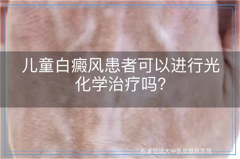 儿童白癜风患者可以进行光化学治疗吗？