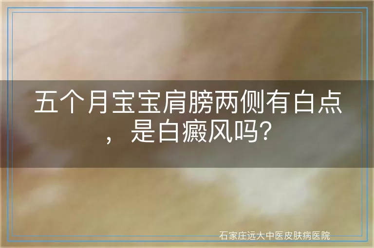 五个月宝宝肩膀两侧有白点，是白癜风吗？
