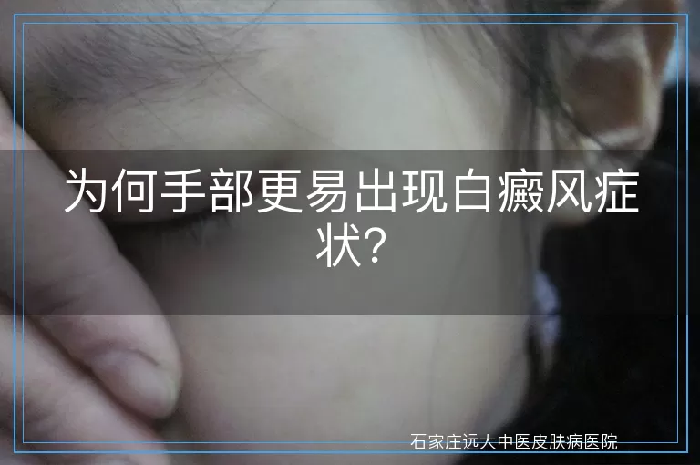 为何手部更易出现白癜风症状？