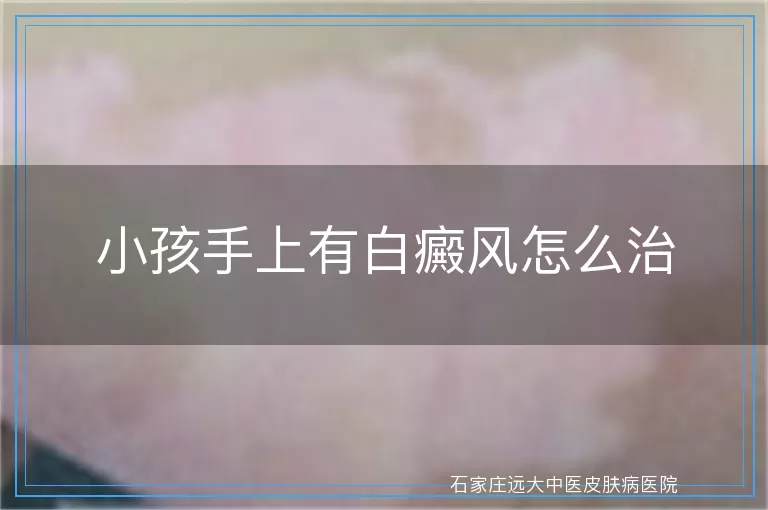 小孩手上有白癜风怎么治
