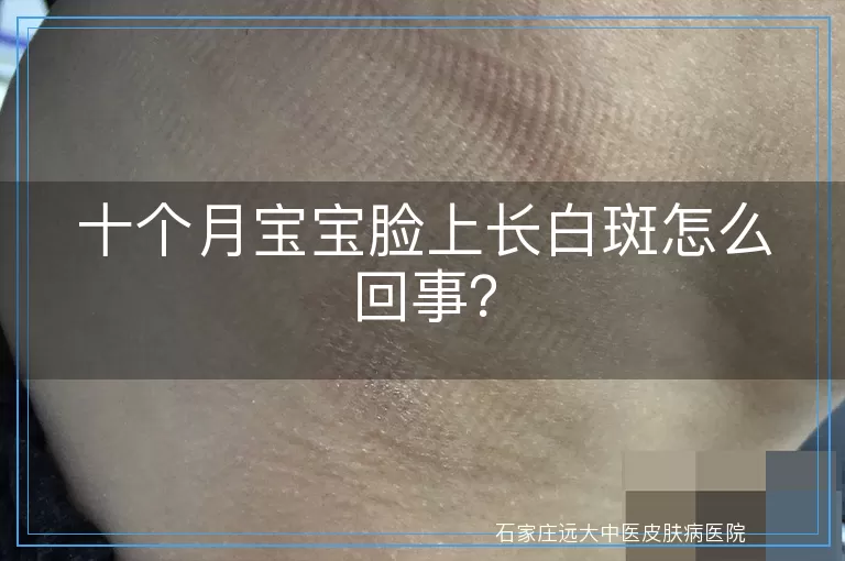 十个月宝宝脸上长白斑怎么回事?