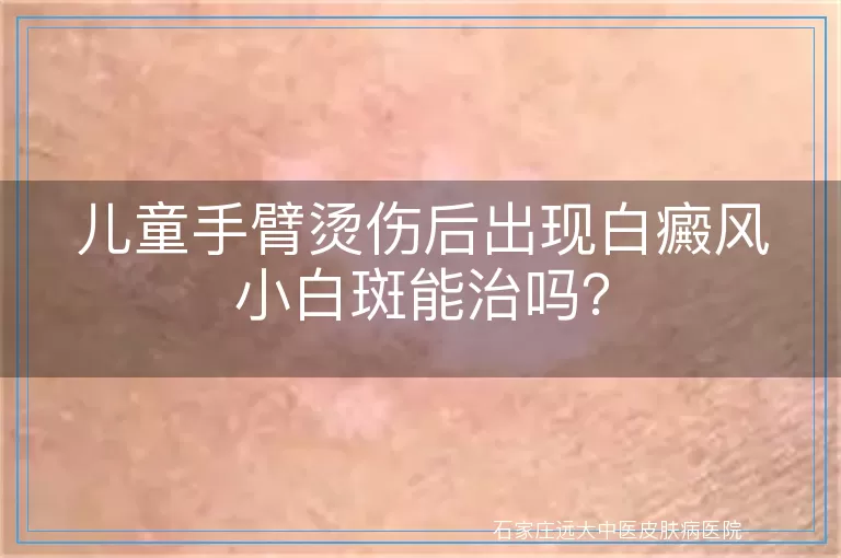 儿童手臂烫伤后出现白癜风小白斑能治吗？
