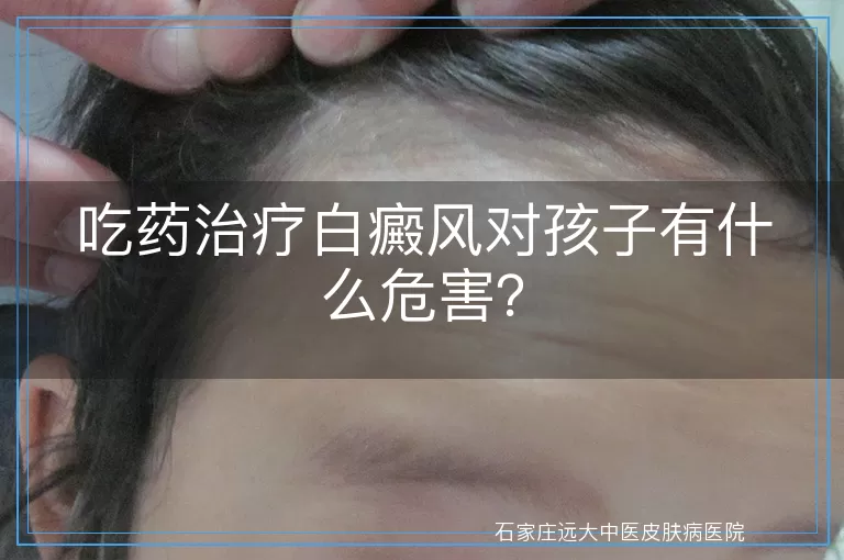 吃药治疗白癜风对孩子有什么危害？