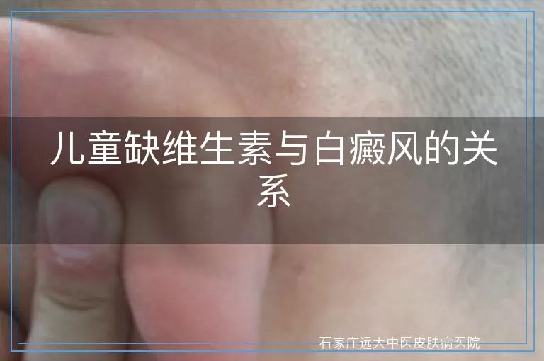 儿童缺维生素与白癜风的关系
