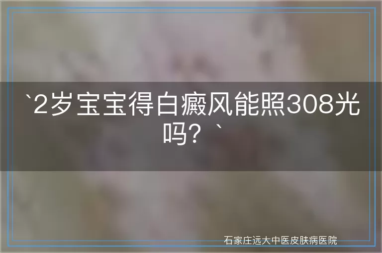 2岁宝宝得白癜风能照308光吗？
