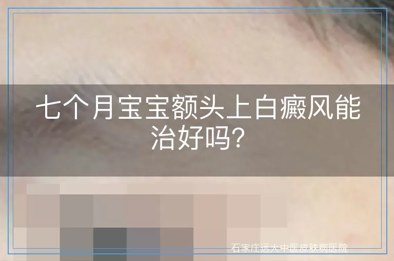 七个月宝宝额头上白癜风能治好吗？