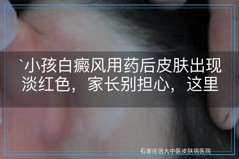 小孩白癜风用药后皮肤出现淡红色，家长别担心，这里有解答