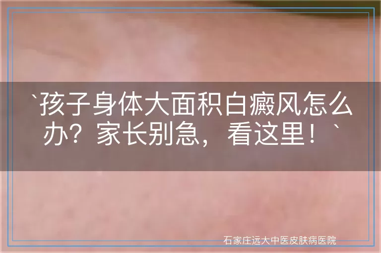 孩子身体大面积白癜风怎么办？家长别急，看这里！