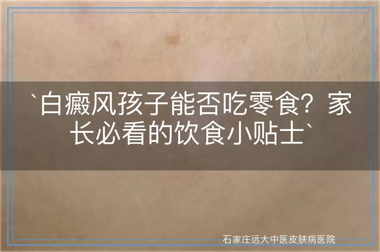 白癜风孩子能否吃零食？家长必看的饮食小贴士