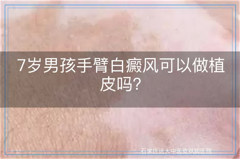 7岁男孩手臂白癜风可以做植皮吗？