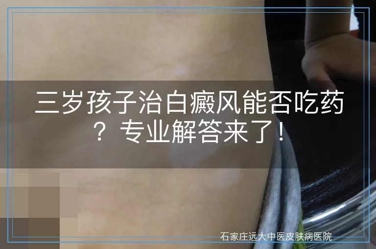 三岁孩子治白癜风能否吃药？专业解答来了！