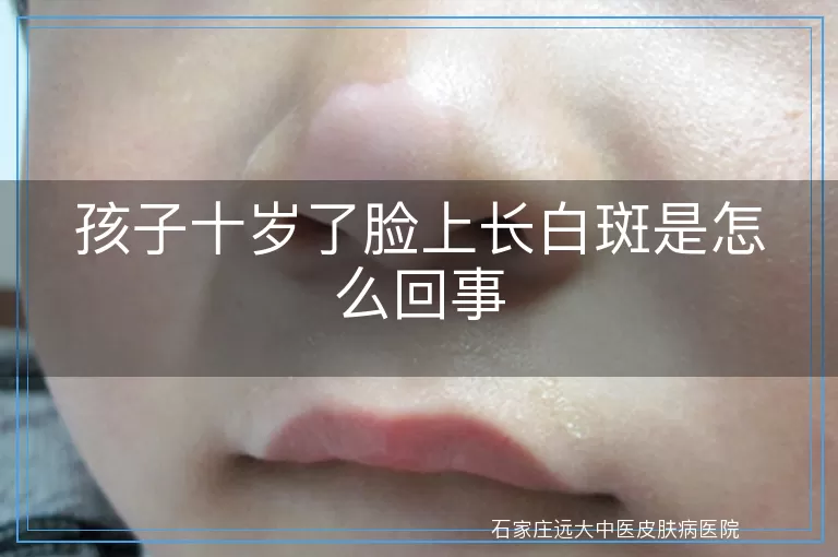 孩子十岁了脸上长白斑是怎么回事