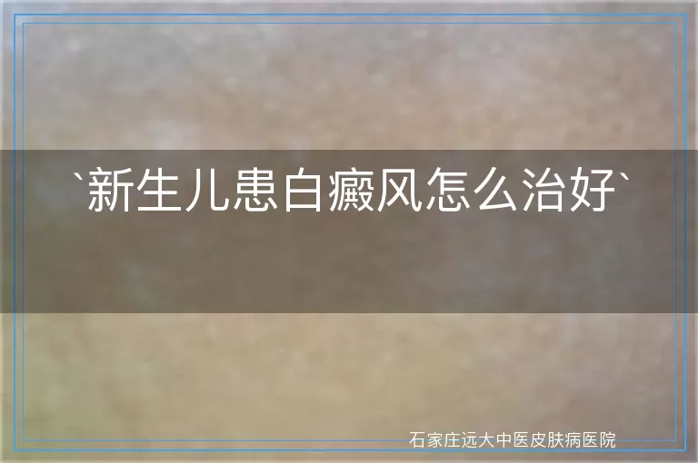 新生儿患白癜风怎么治好