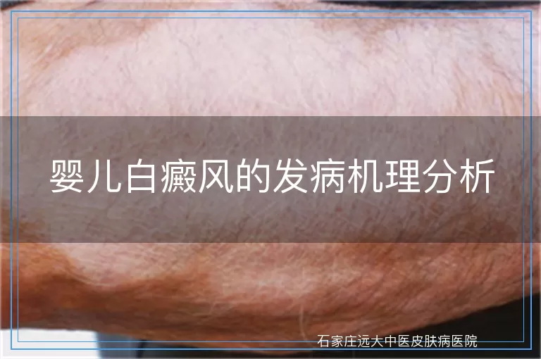 婴儿白癜风的发病机理分析