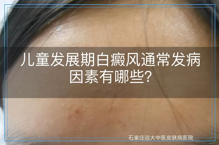 儿童发展期白癜风通常发病因素有哪些？