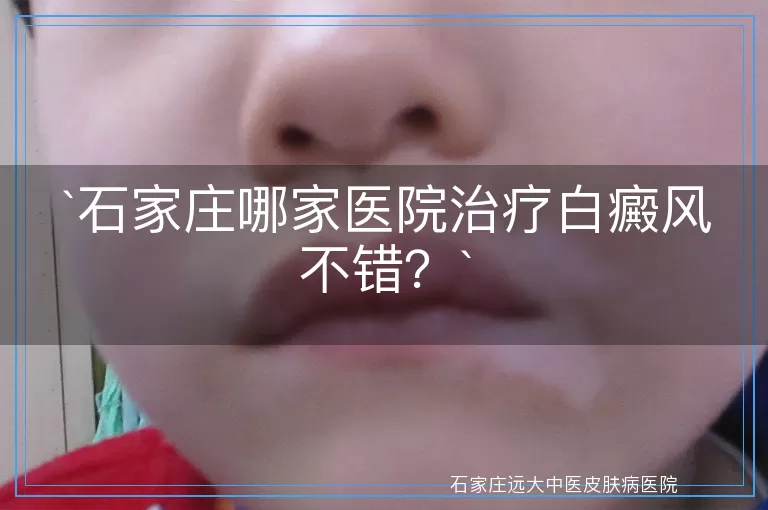 石家庄哪家医院治疗白癜风不错？