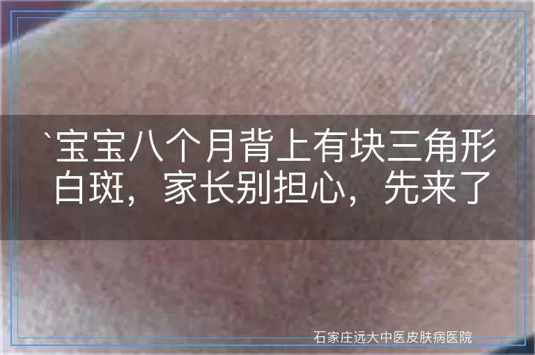 宝宝八个月背上有块三角形白斑，家长别担心，先来了解这些！