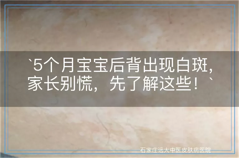 5个月宝宝后背出现白斑，家长别慌，先了解这些！