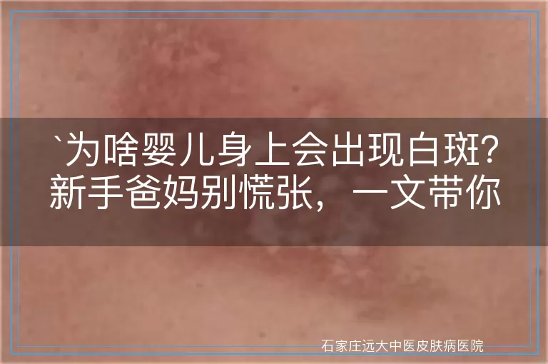 为啥婴儿身上会出现白斑？新手爸妈别慌张，一文带你了解真相