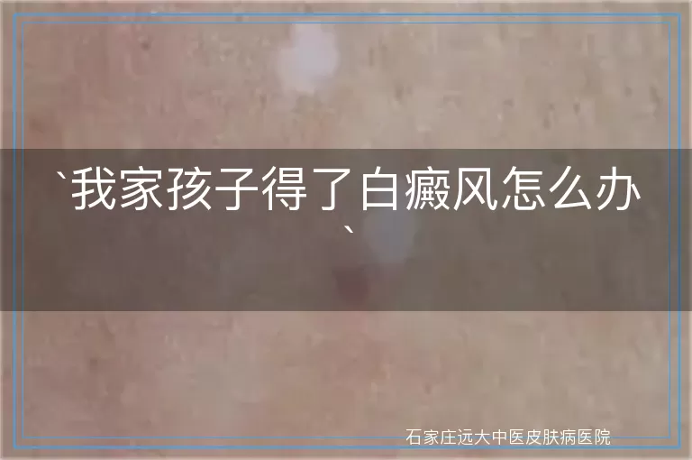 我家孩子得了白癜风怎么办