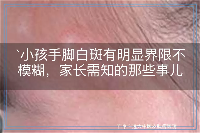 小孩手脚白斑有明显界限不模糊，家长需知的那些事儿