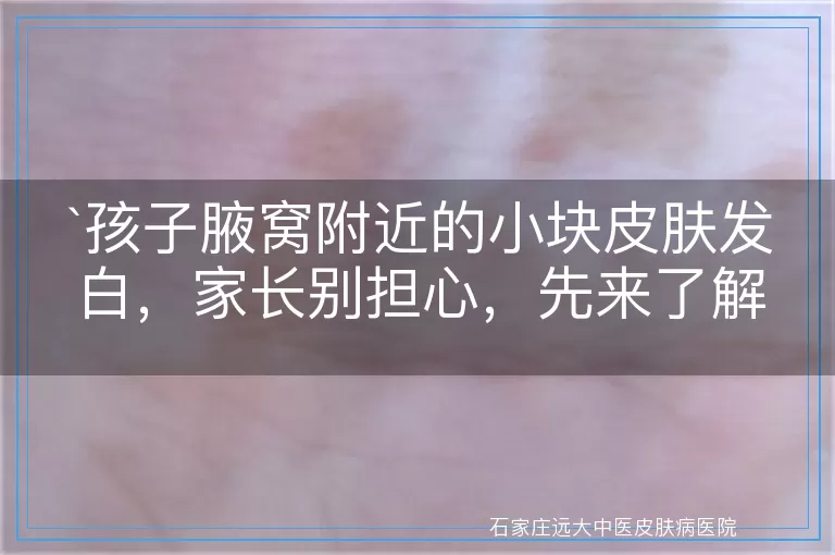 孩子腋窝附近的小块皮肤发白，家长别担心，先来了解这些