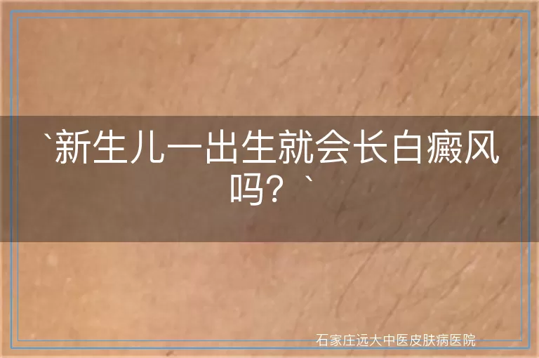 新生儿一出生就会长白癜风吗？