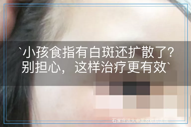 小孩食指有白斑还扩散了？别担心，这样治疗更有效