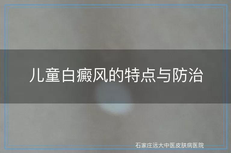 儿童白癜风的特点与防治