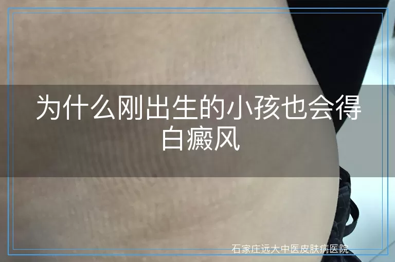 为什么刚出生的小孩也会得白癜风