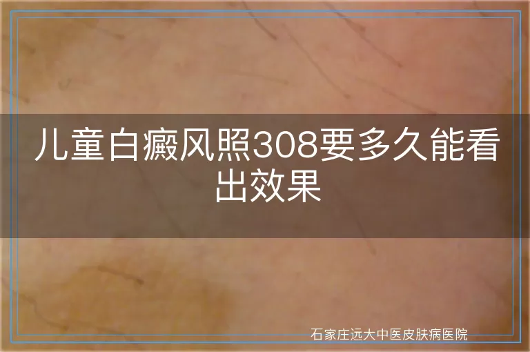 儿童白癜风照308要多久能看出效果