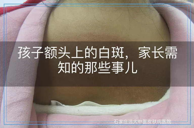 孩子额头上的白斑，家长需知的那些事儿