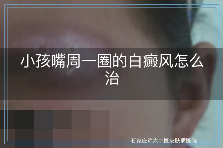 小孩嘴周一圈的白癜风怎么治
