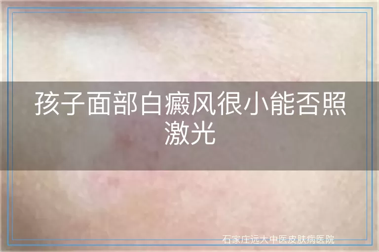 孩子面部白癜风很小能否照激光