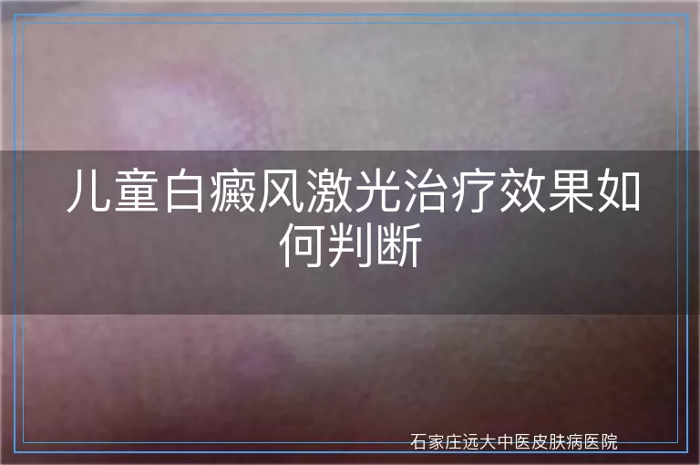儿童白癜风激光治疗效果如何判断