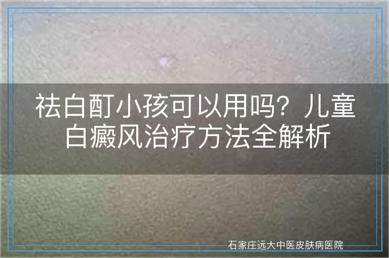 祛白酊小孩可以用吗？儿童白癜风治疗方法全解析