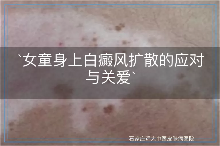 女童身上白癜风扩散的应对与关爱