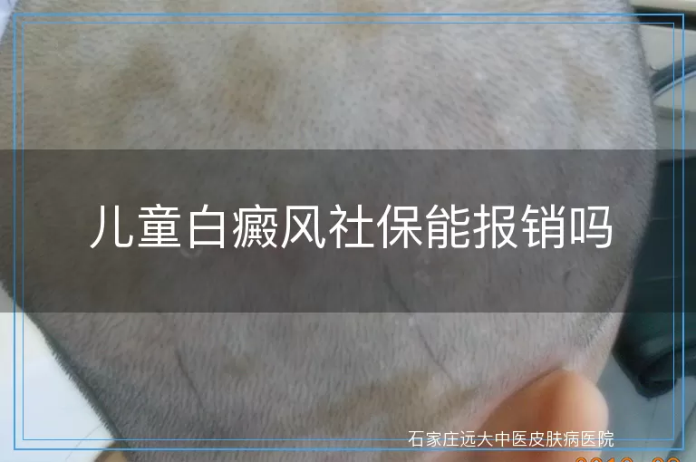 儿童白癜风社保能报销吗