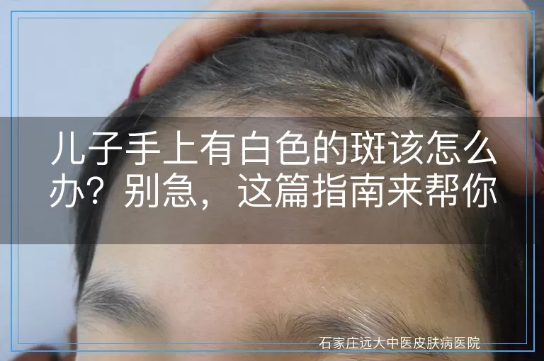 儿子手上有白色的斑该怎么办？别急，这篇指南来帮你！