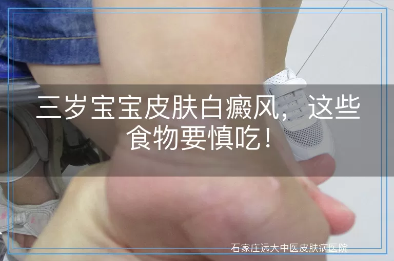 三岁宝宝皮肤白癜风，这些食物要慎吃！