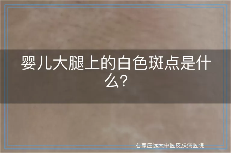 婴儿大腿上的白色斑点是什么？