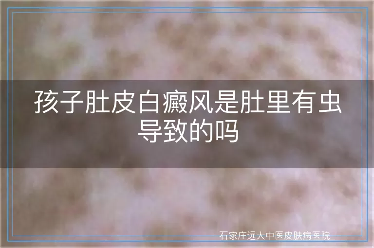 孩子肚皮白癜风是肚里有虫导致的吗
