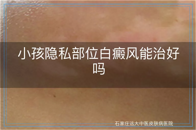 小孩隐私部位白癜风能治好吗