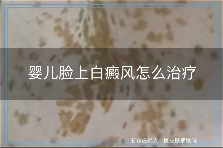 婴儿脸上白癜风怎么治疗