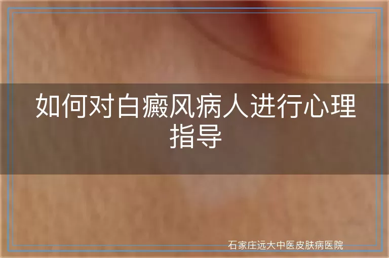 如何对白癜风病人进行心理指导